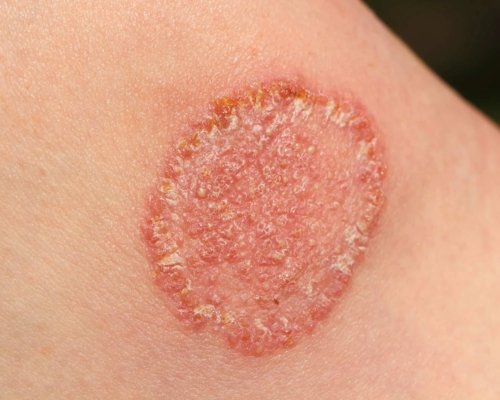 Fungal & Skin Infections in Roorkee